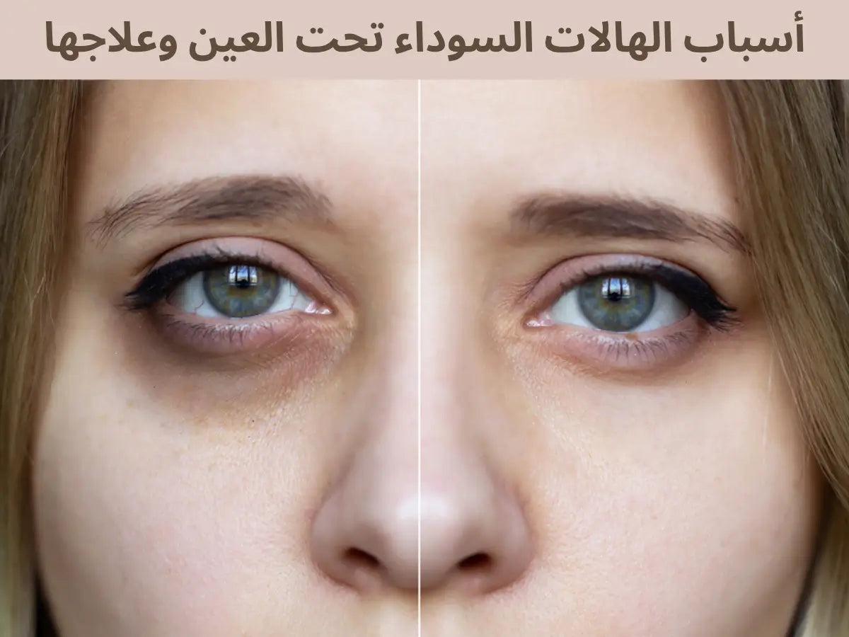 أسباب الهالات السوداء تحت العين وعلاجها